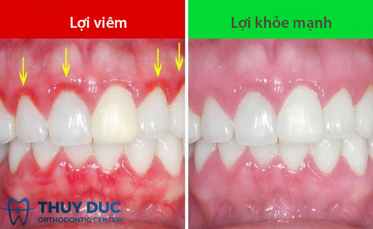 1. Viêm lợi là gì? 1