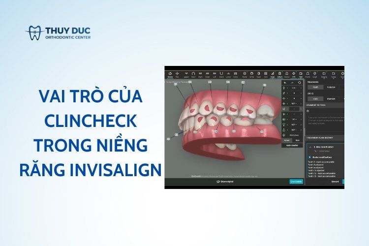 Tại sao ClinCheck quan trọng trong niềng răng Invisalign?