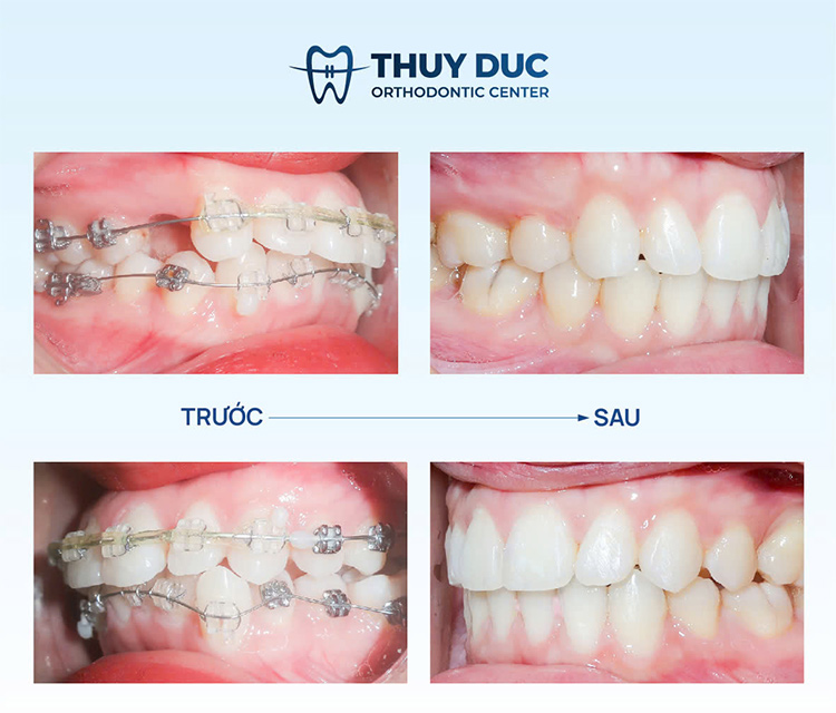 1. Niềng răng mắc cài kim loại 1