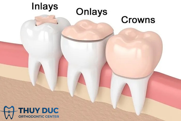1.1. Trám răng Inlay là gì? 1