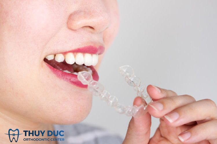 Một số câu hỏi liên quan đến niềng răng Invisalign 1