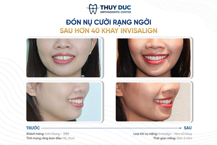 Mách bạn địa chỉ niềng răng Invisalign uy tín tại Hà Nội 4