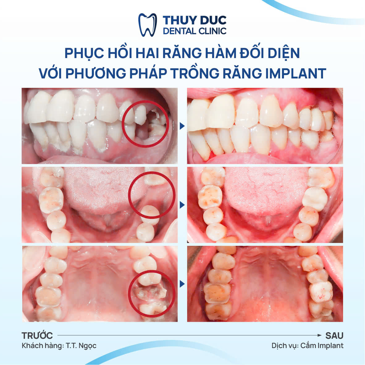 5.2. Răng bị mất hoặc tổn thương vĩnh viễn 1