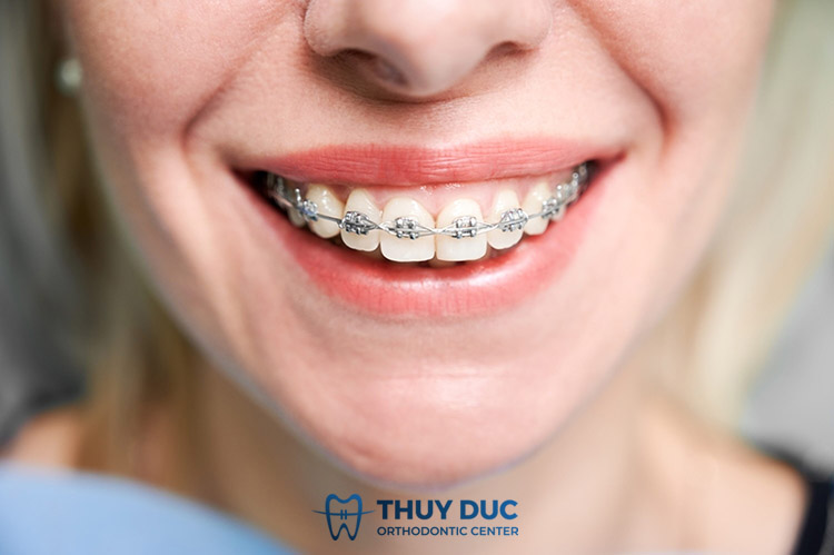 Trước thời điểm niềng răng Invisalign ra đời 1