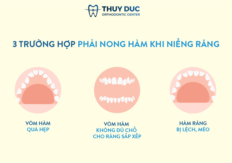 Những trường hợp nào cần nong hàm cho trẻ em? 1