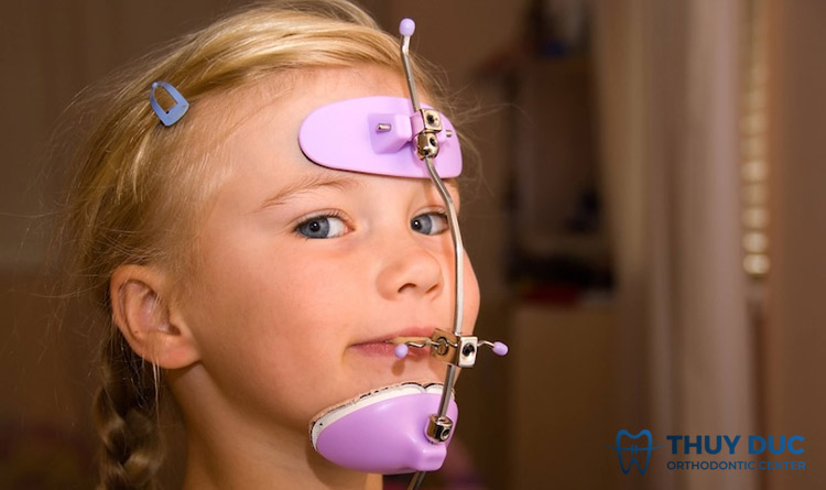 Facemask – Khí cụ nắn chỉnh xương hàm móm cho bé 1