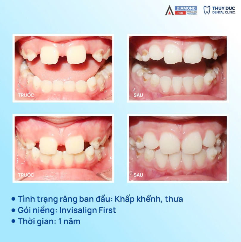 Hình ảnh review khách hàng - trước sau niềng răng thưa tại Nha khoa Thúy Đức 1