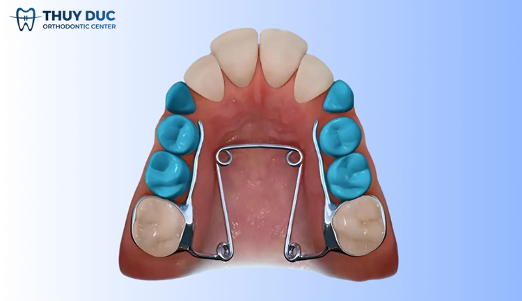 Quad – Helix – Khí cụ nong rộng cung hàm, tạo khoảng trống 1
