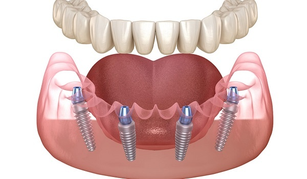 Nguyên nhân dẫn đến trồng răng implant có giá rẻ 2