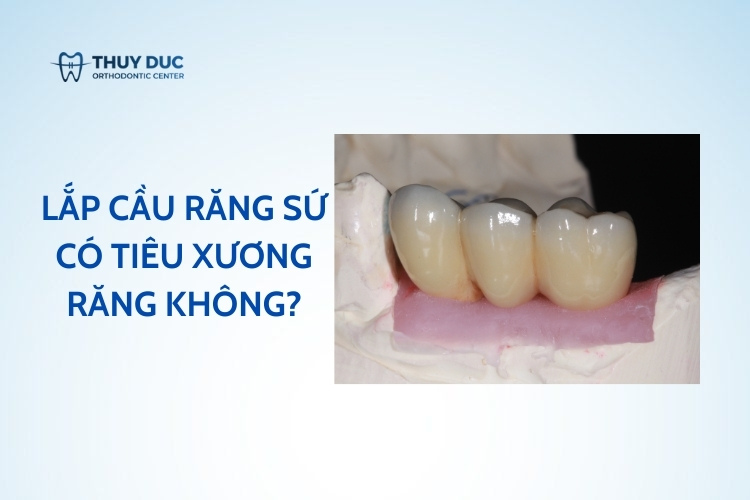 Làm cầu răng có bị tiêu xương không?