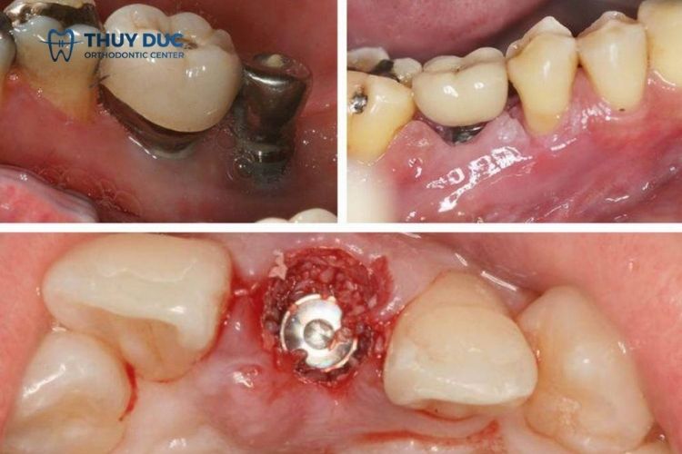 Trồng răng giá rẻ có an toàn không? 2
