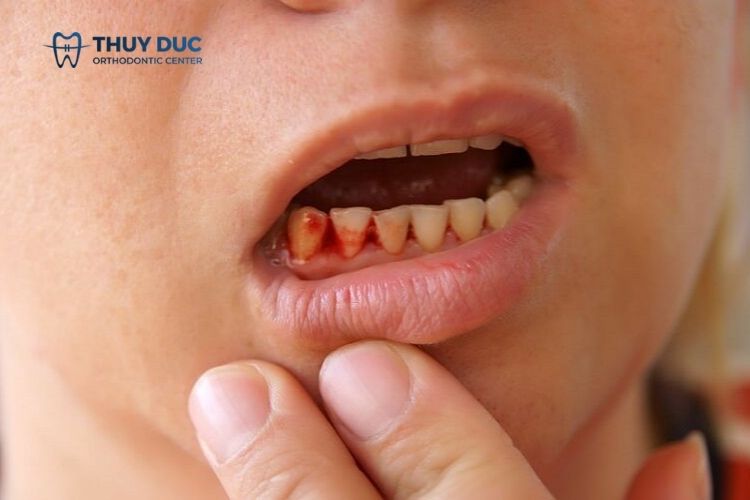 Trồng răng giá rẻ có an toàn không? 3