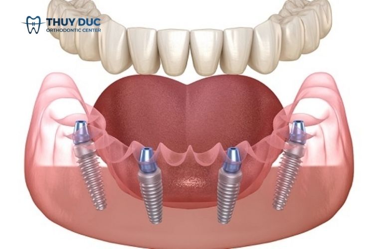Những điều cần biết về phương pháp cấy ghép implant 1