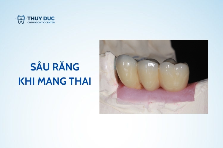 Sâu răng ở phụ nữ mang thai – thời điểm và cách điều trị