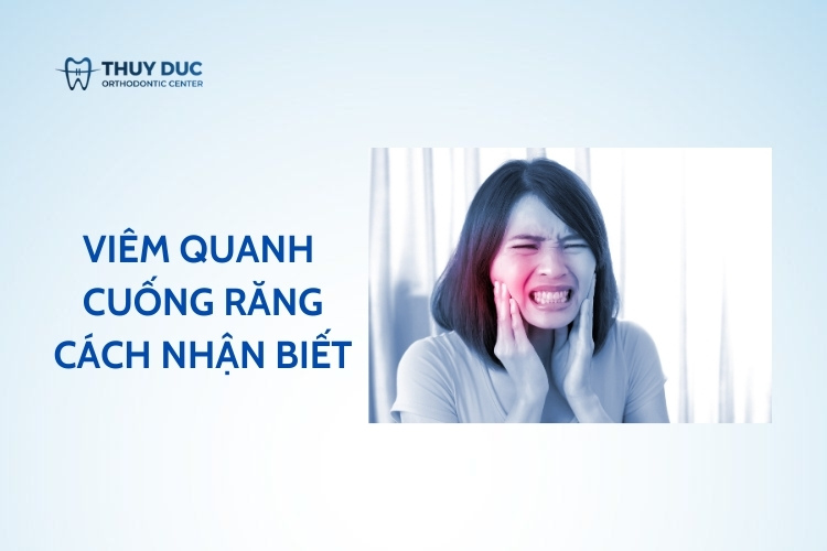 Viêm quanh cuống răng – giai đoạn cấp và mãn tính