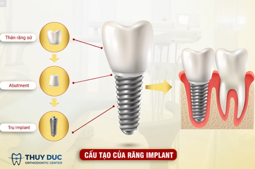 Đặc điểm cấu tạo trụ răng implant 1