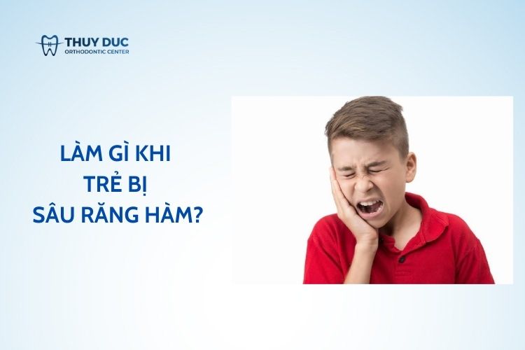Làm gì khi trẻ bị sâu răng hàm? Các phương pháp điều trị tốt nhất