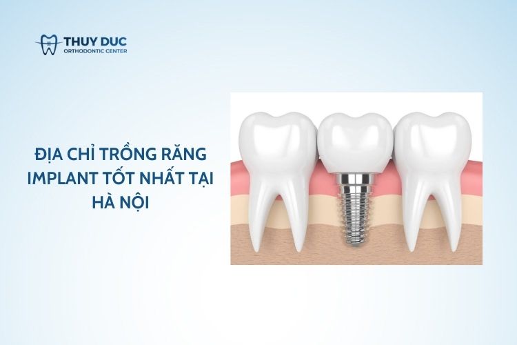 Địa chỉ trồng răng implant tốt nhất tại Hà Nội