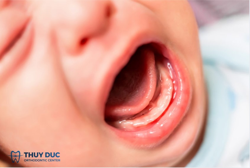 1. Trẻ 2 tháng tuổi bị nhiệt miệng có phổ biến không? 1