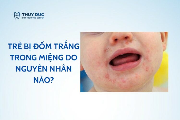 Trẻ bị đốm trắng trong miệng do nguyên nhân nào?