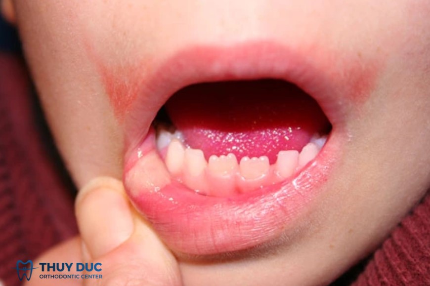 Bạch sản (leukoplakia) 1
