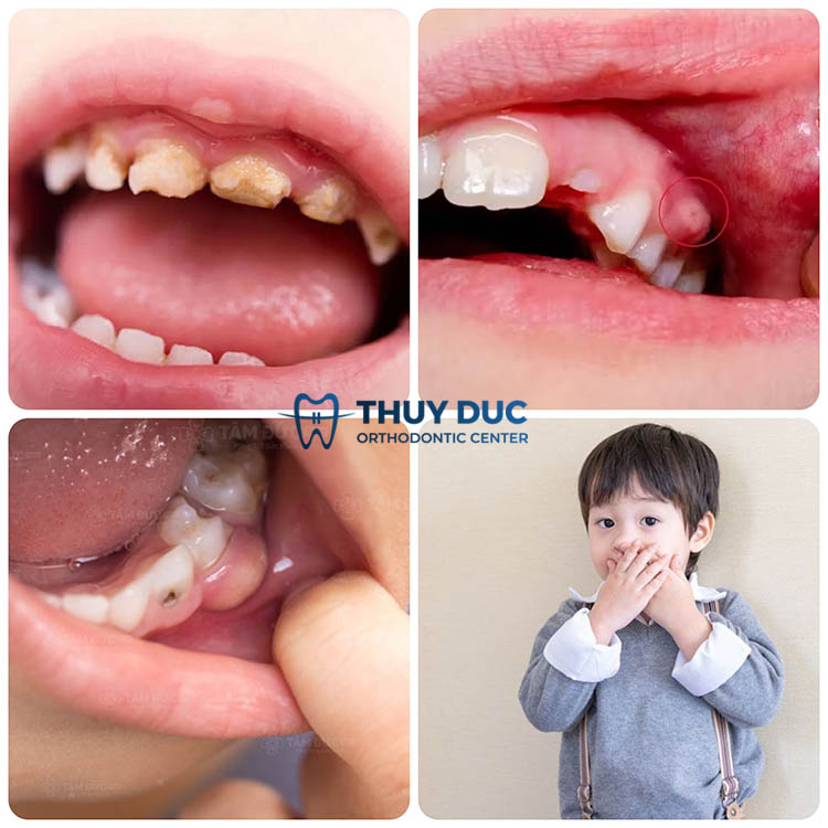 Biến chứng tiềm ẩn của viêm lợi chảy máu chân răng ở trẻ em 1
