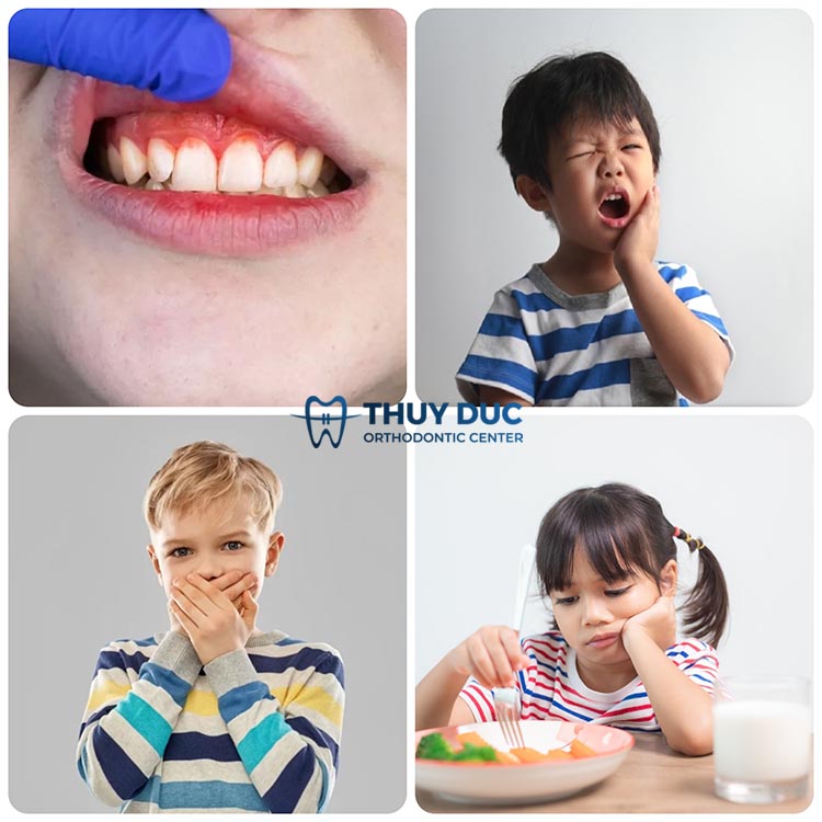 Các giai đoạn phát triển bệnh viêm lợi ở trẻ em 2