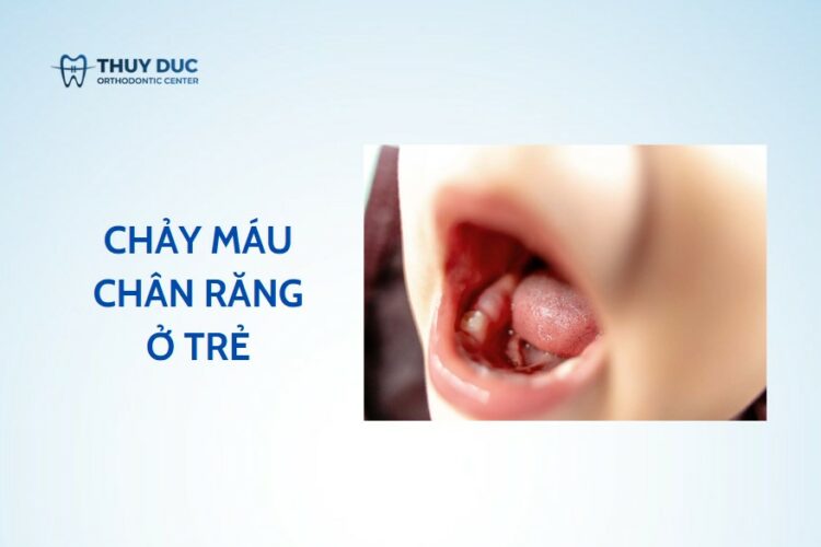 Chảy máu chân răng ở trẻ nhỏ – hiểu nguyên nhân và xử lý