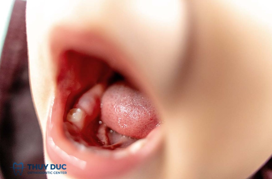 1. Chảy máu chân răng ở trẻ - tại sao không nên coi thường? 1