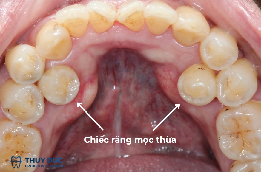 1. Răng thừa là gì? Nhận diện sớm để tránh biến chứng 1
