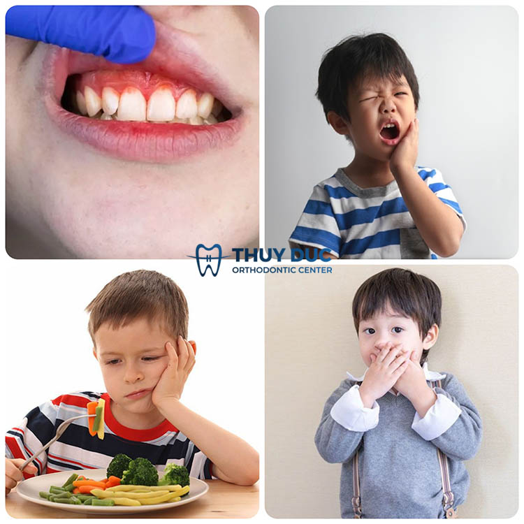 Giai đoạn nặng (Giai đoạn tiến triển) 1