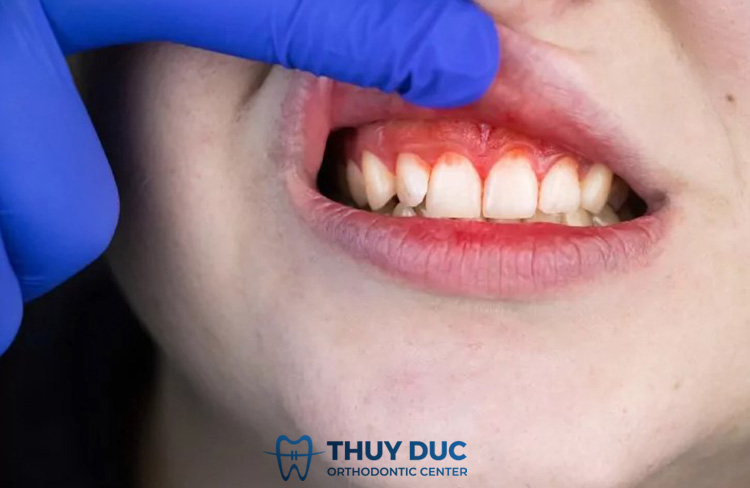 Dấu hiệu nhận biết viêm lợi chảy máu chân răng ở trẻ em 1