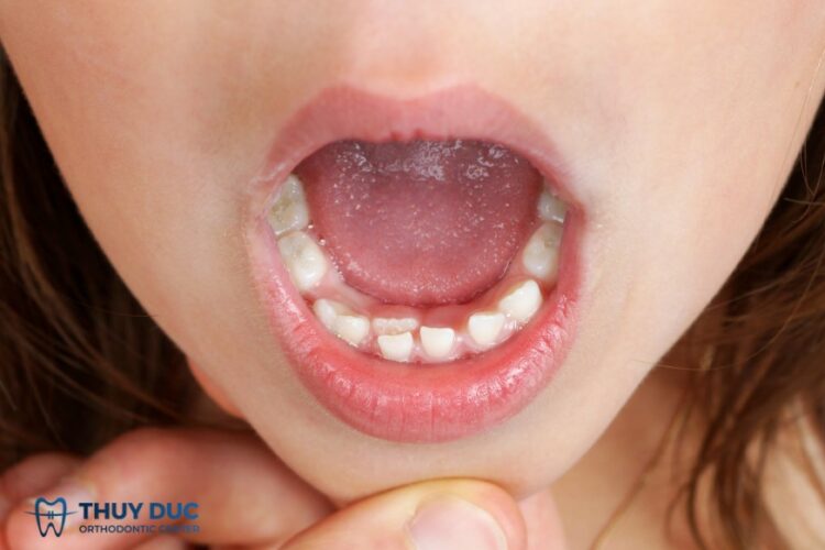 Răng mọc lẫy ở trẻ do đâu, có phải nhổ bỏ không?