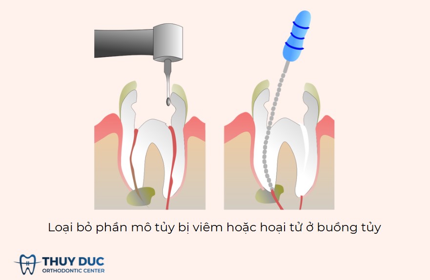 3.1. Điều trị viêm chóp răng 1