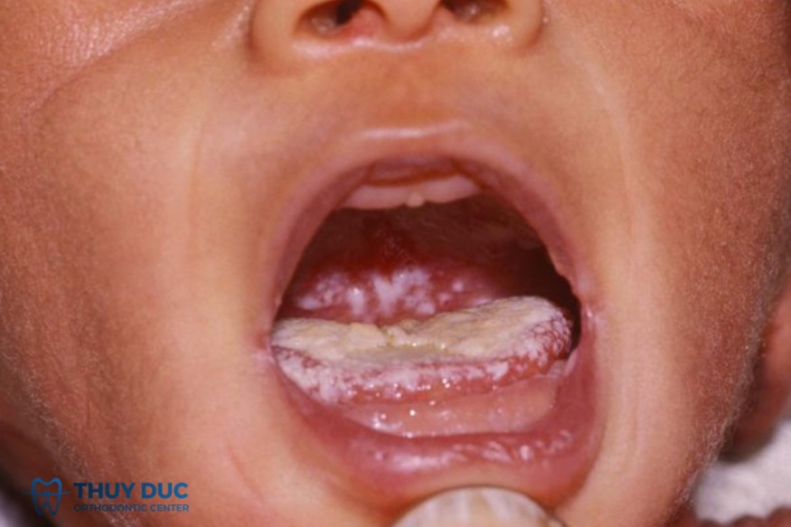 3. Dấu hiệu nhận biết nấm miệng ở trẻ sơ sinh 1