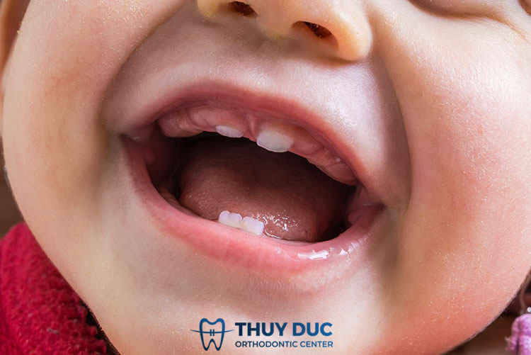 Các nguyên nhân gây viêm lợi có mủ ở trẻ em 2