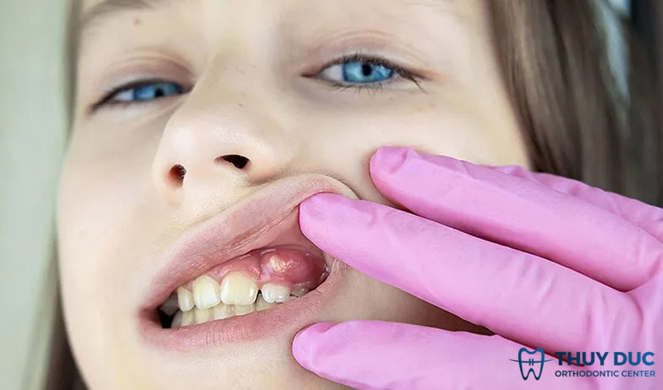 Nhận biết tình trạng viêm lợi có mủ ở trẻ em 1