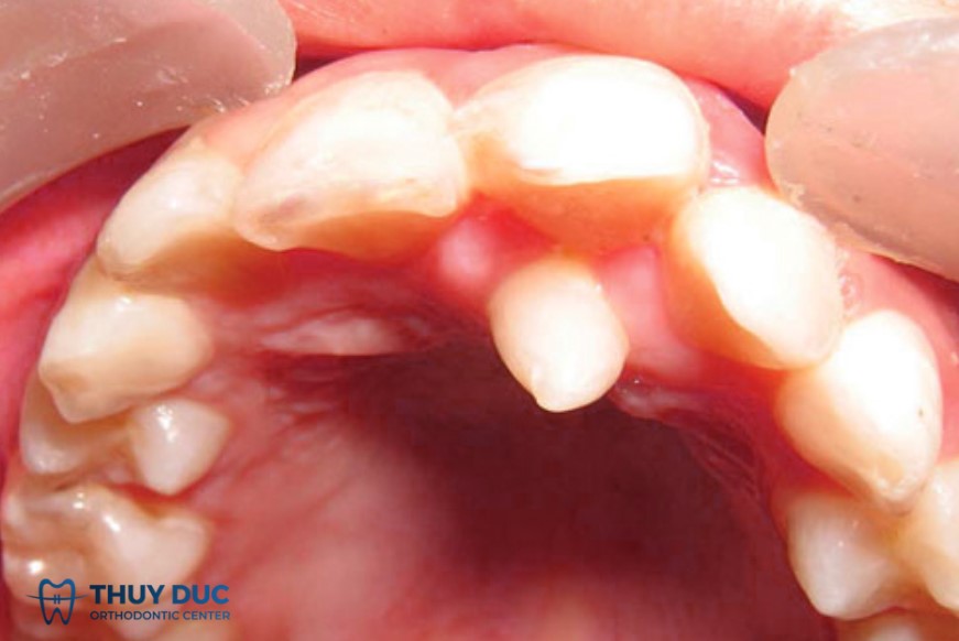 2. Dấu hiệu nhận biết trẻ mọc răng thừa 1