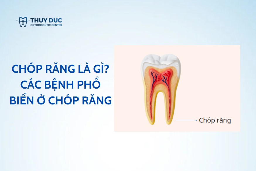 Chóp răng là gì? Các bệnh phổ biến ở chóp răng