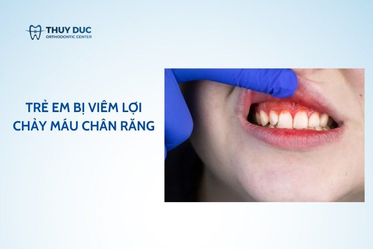 Trẻ em bị viêm lợi chảy máu chân răng phải làm sao?