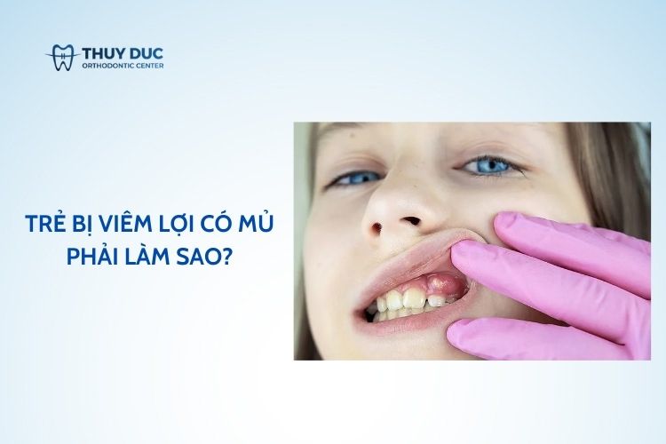 Trẻ bị viêm lợi có mủ phải làm sao?Hướng dẫn cách xử lý tốt nhất