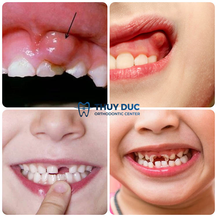 Nguy cơ biến chứng răng miệng nghiêm trọng 1