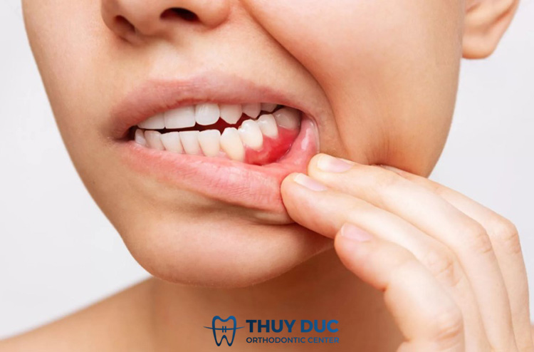 Viêm lợi do tác dụng phụ của thuốc 1