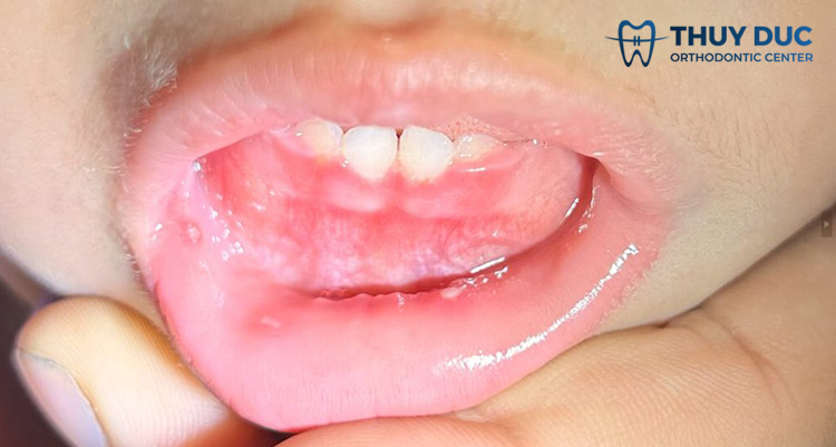 Viêm lợi do vi khuẩn 1