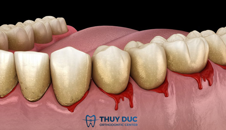 Viêm lợi do bệnh về máu 1