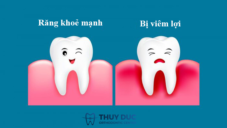 Viêm lợi ở trẻ em là gì? 1