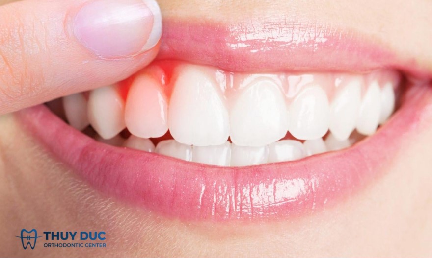 1. Khi nào có thể chữa viêm lợi tại nhà? 1