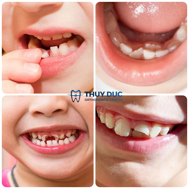 Các trường hợp cần đưa bé đi nhổ răng sữa tại phòng khám 1