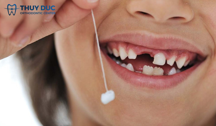 Có nên nhổ răng sữa cho bé tại nhà? 1