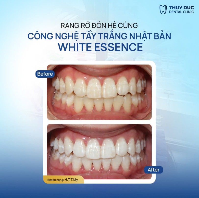 Công nghệ White Essence Nhật Bản, trải nghiệm êm ái:  1